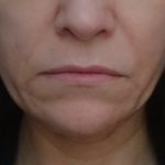 Aknebehandlung Kosmetikstudio Rottweil und Oberndorf Botox