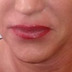Korrektur der Lippe