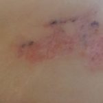 Tattoo lasern Balingen tuttlingen Villingen-Schwenningen Oberndorf am Neckar