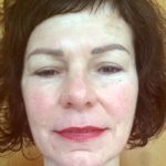 Lippenvergößerung Foto nachher Rottweil