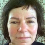 Lippenvergrößerung Rottweil Lippen aufspritzen