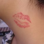 Tattoo entfernen am Hals Rottweil Balingen Villingen-Schwenningen Bad Dürrheim