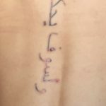 Tattoo lasern Rottweil Villingen-Schwenningen Albstadt-Ebingen