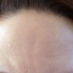 Altersflecken Pigmentflecken entfernen Rottweil Oberndorf