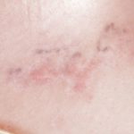 Tattoo Schrift entfernt Oberndorf am neckar und Balingen Albstadt-Ebingen